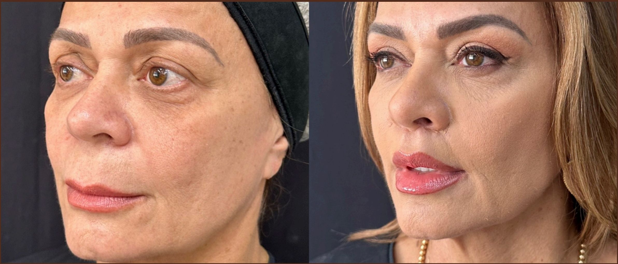 Antes e depois: Blefaroplastia + Lip Lift