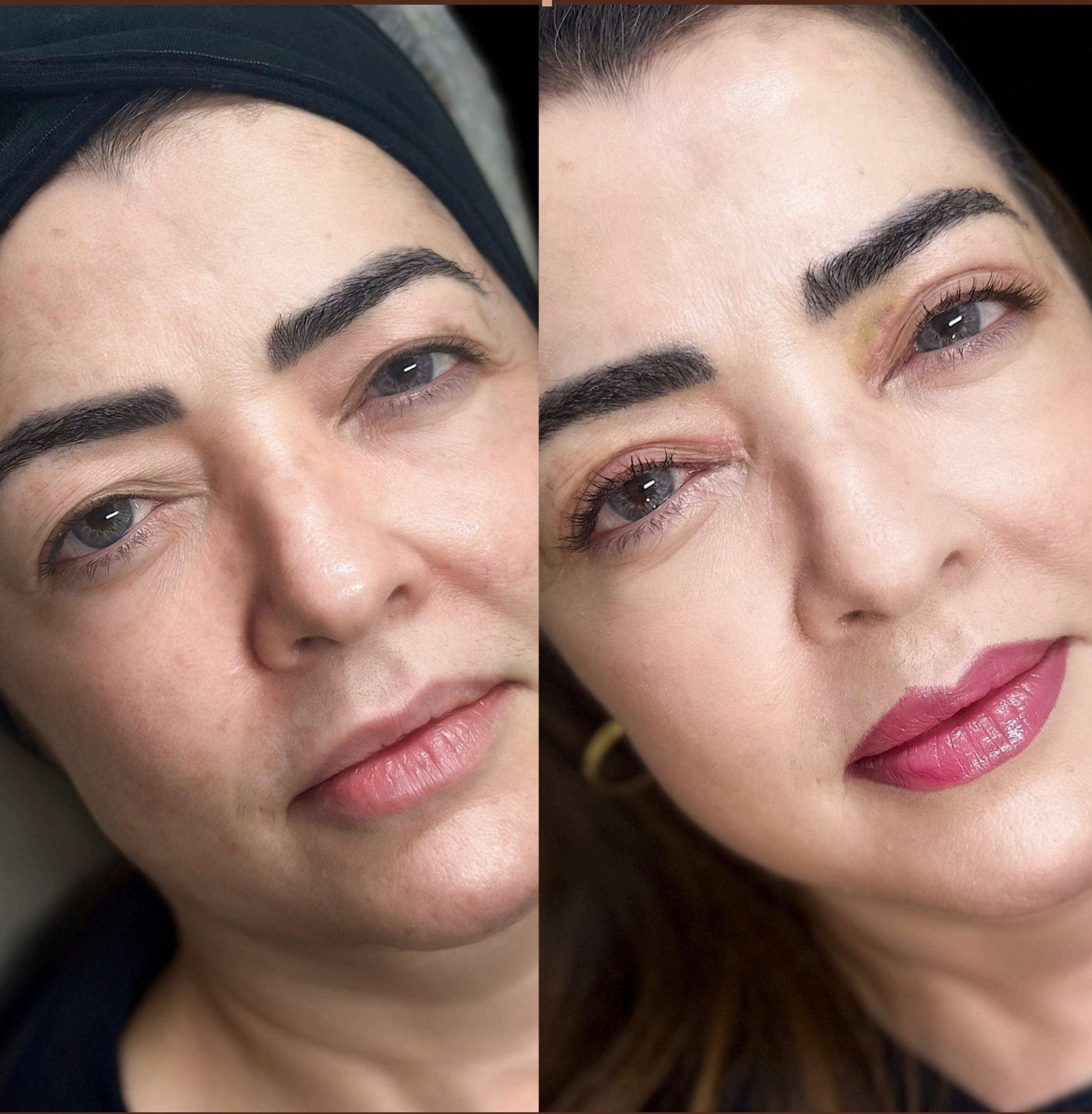 Antes e depois: Blefaroplastia