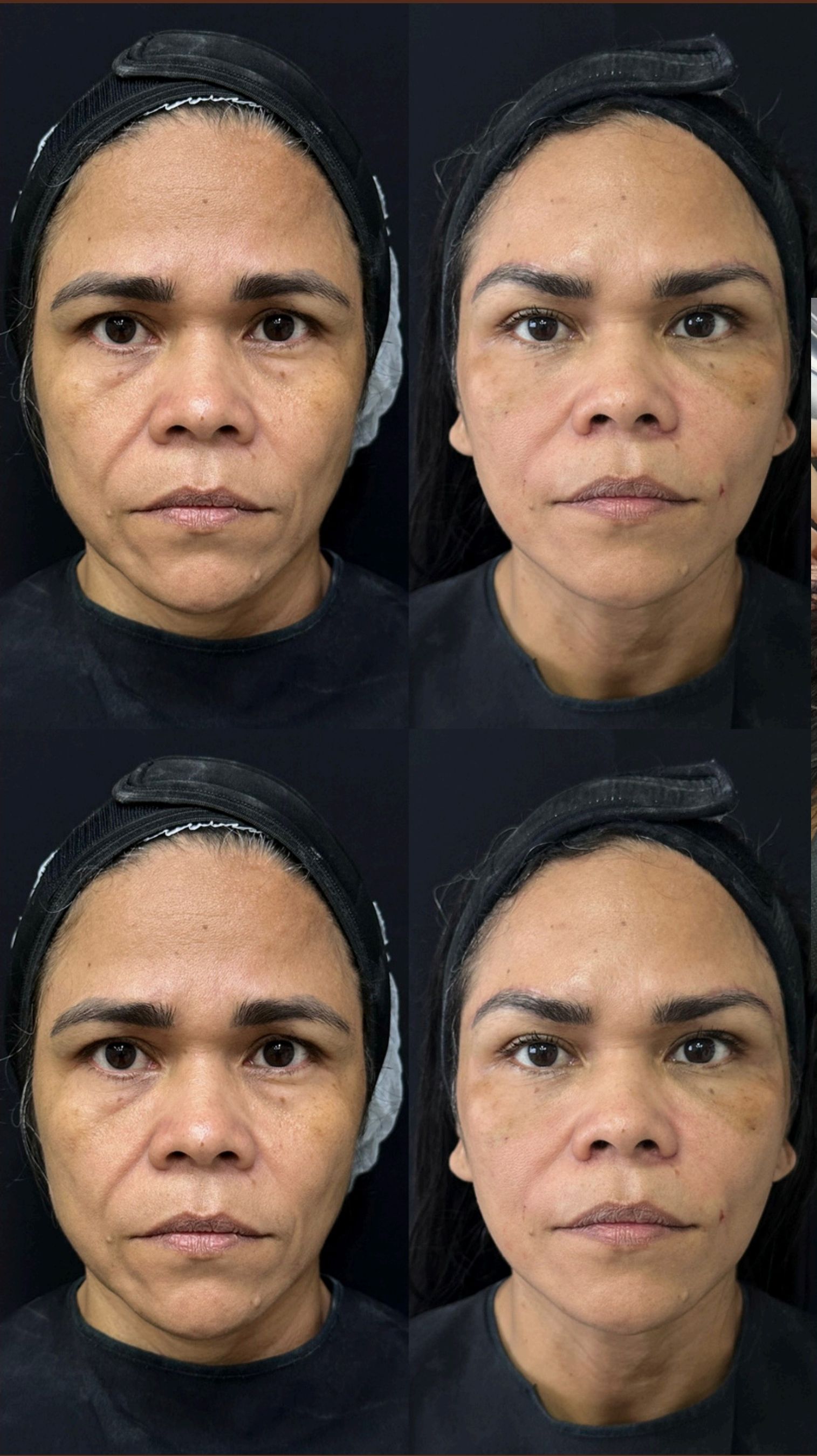 Antes e depois: Lifting de Sobrancelhas (Brow Lift)