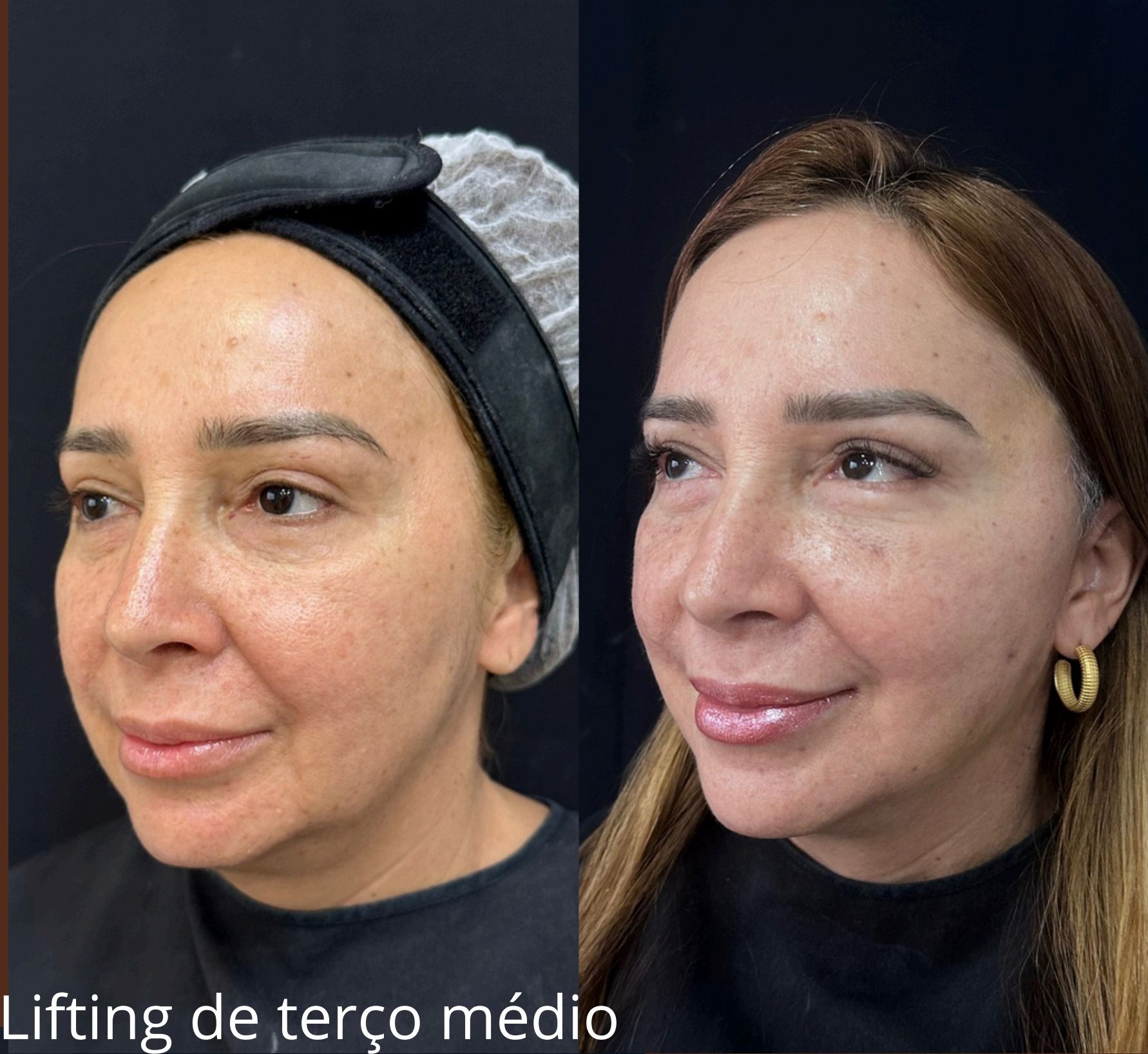 Antes e depois: Lifting de Terço Médio