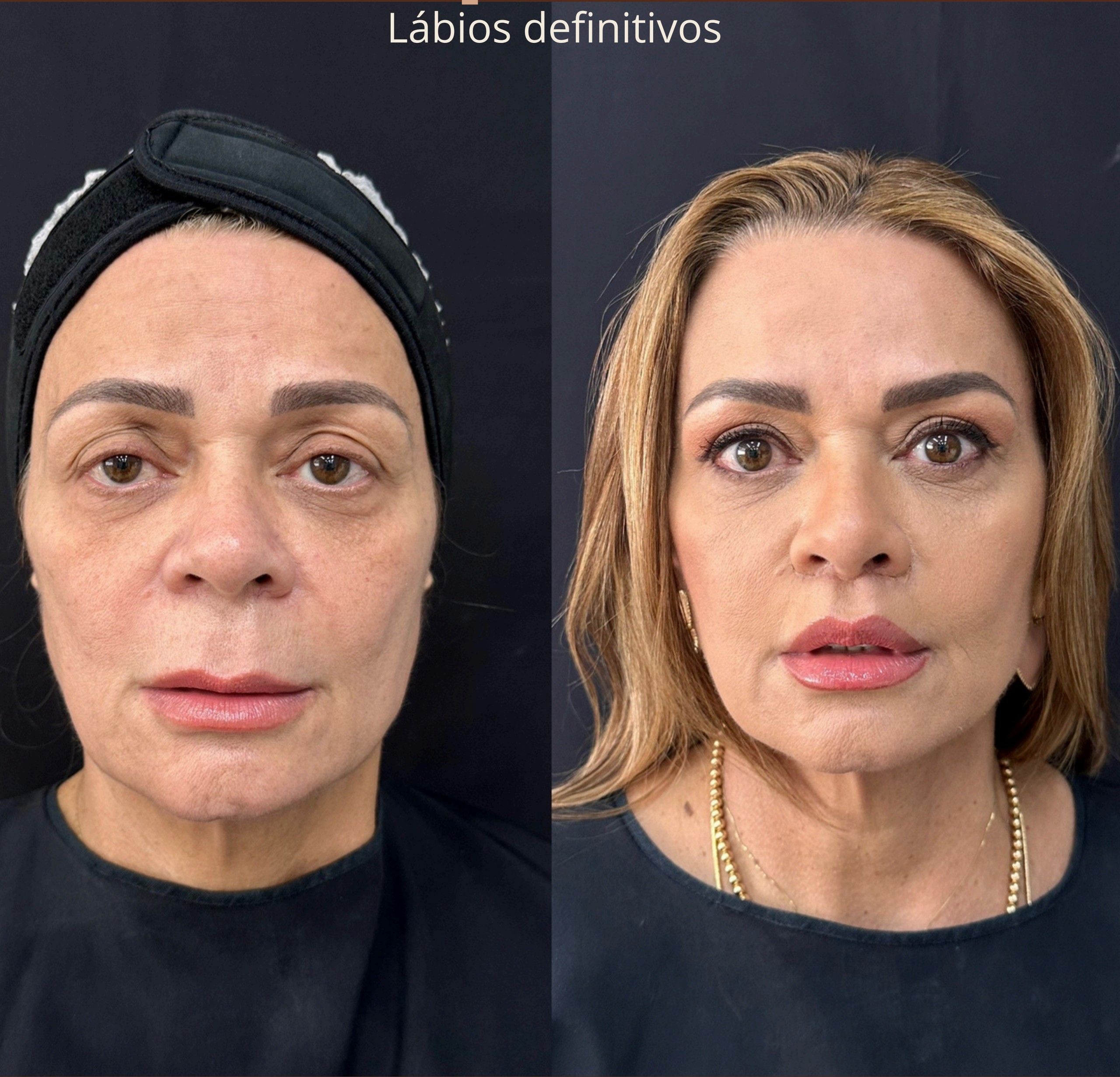 Antes e depois: Lip Lift