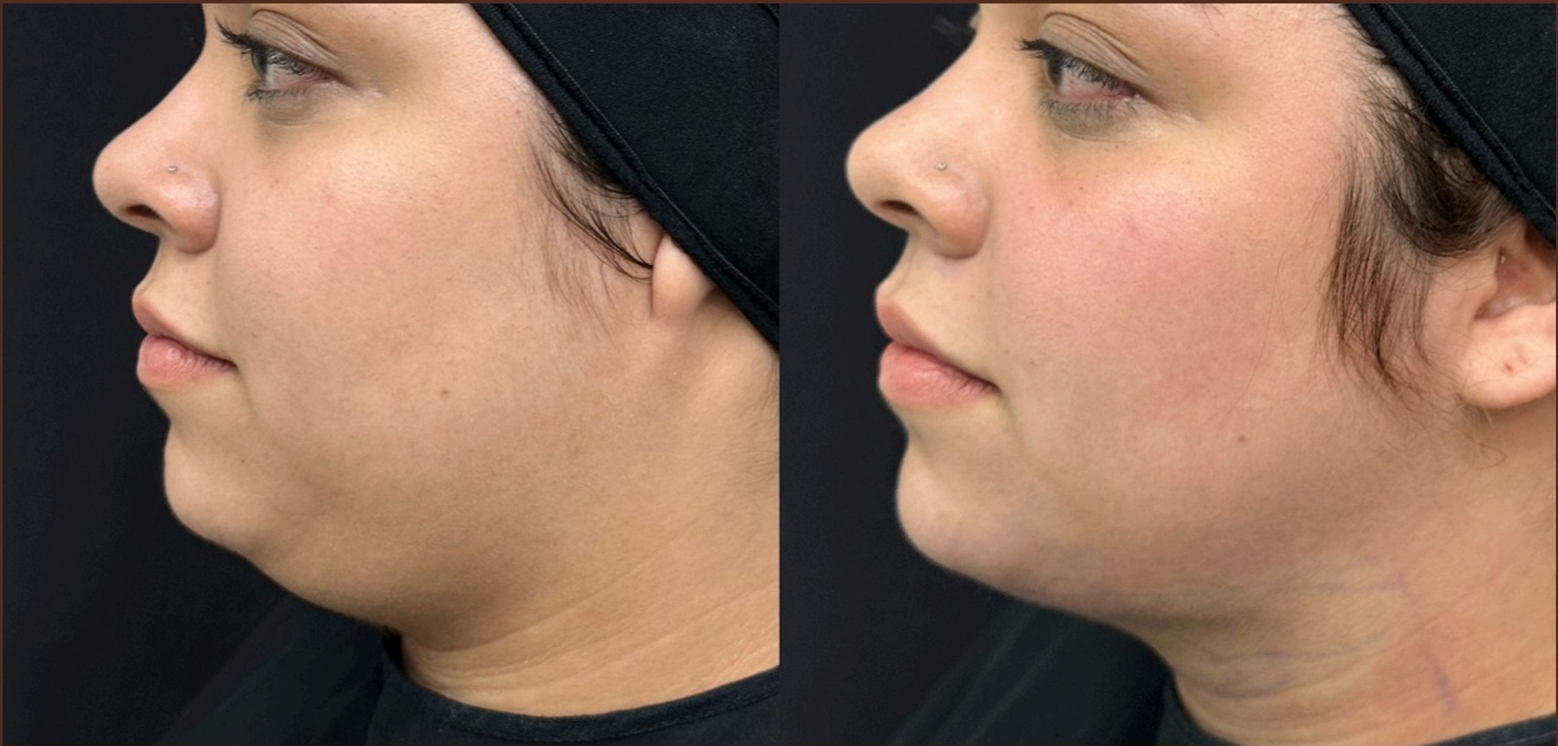 Antes e depois: Lipoaspiração de Papada