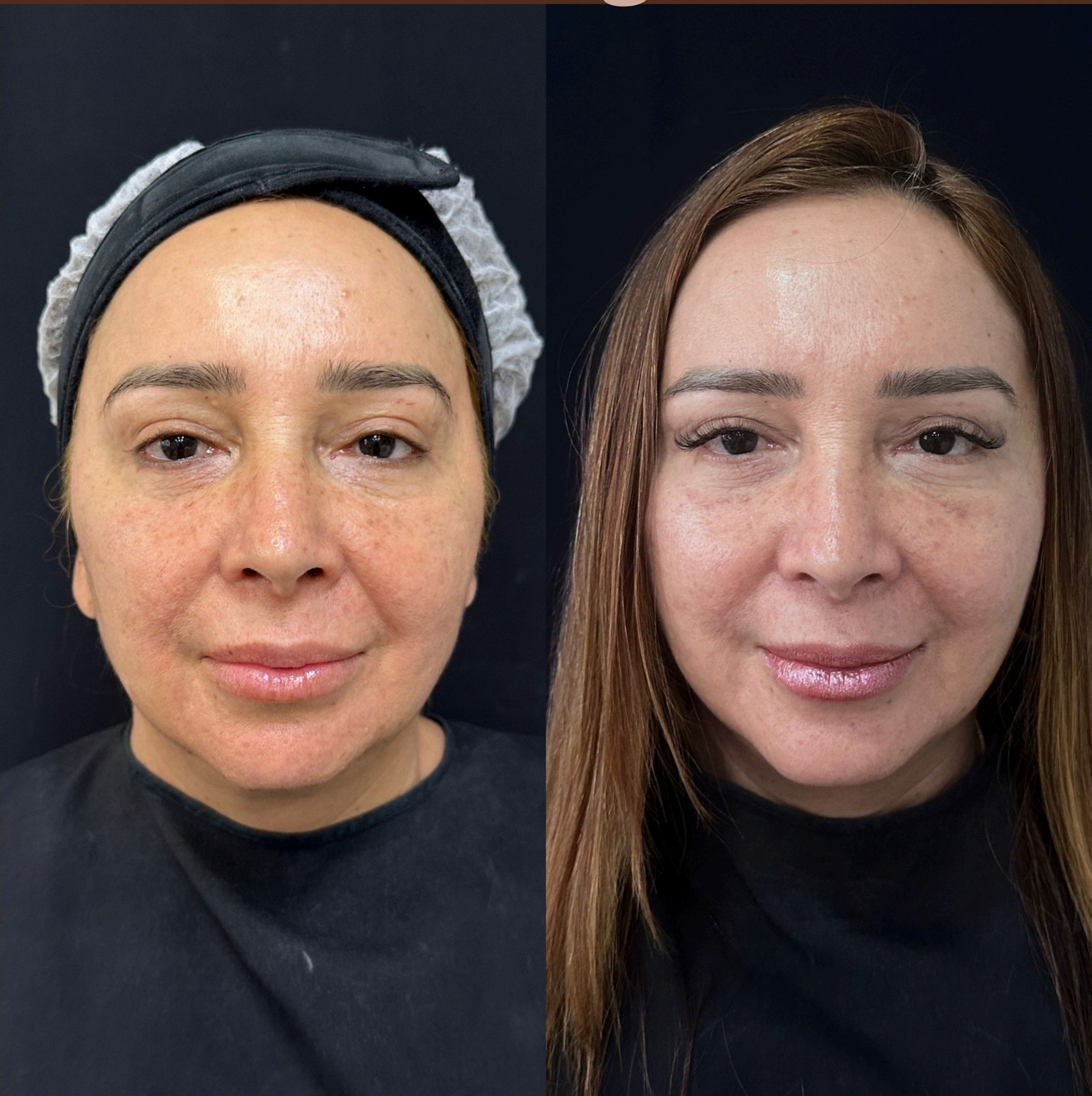 Antes e depois: Mini Lifting Facial