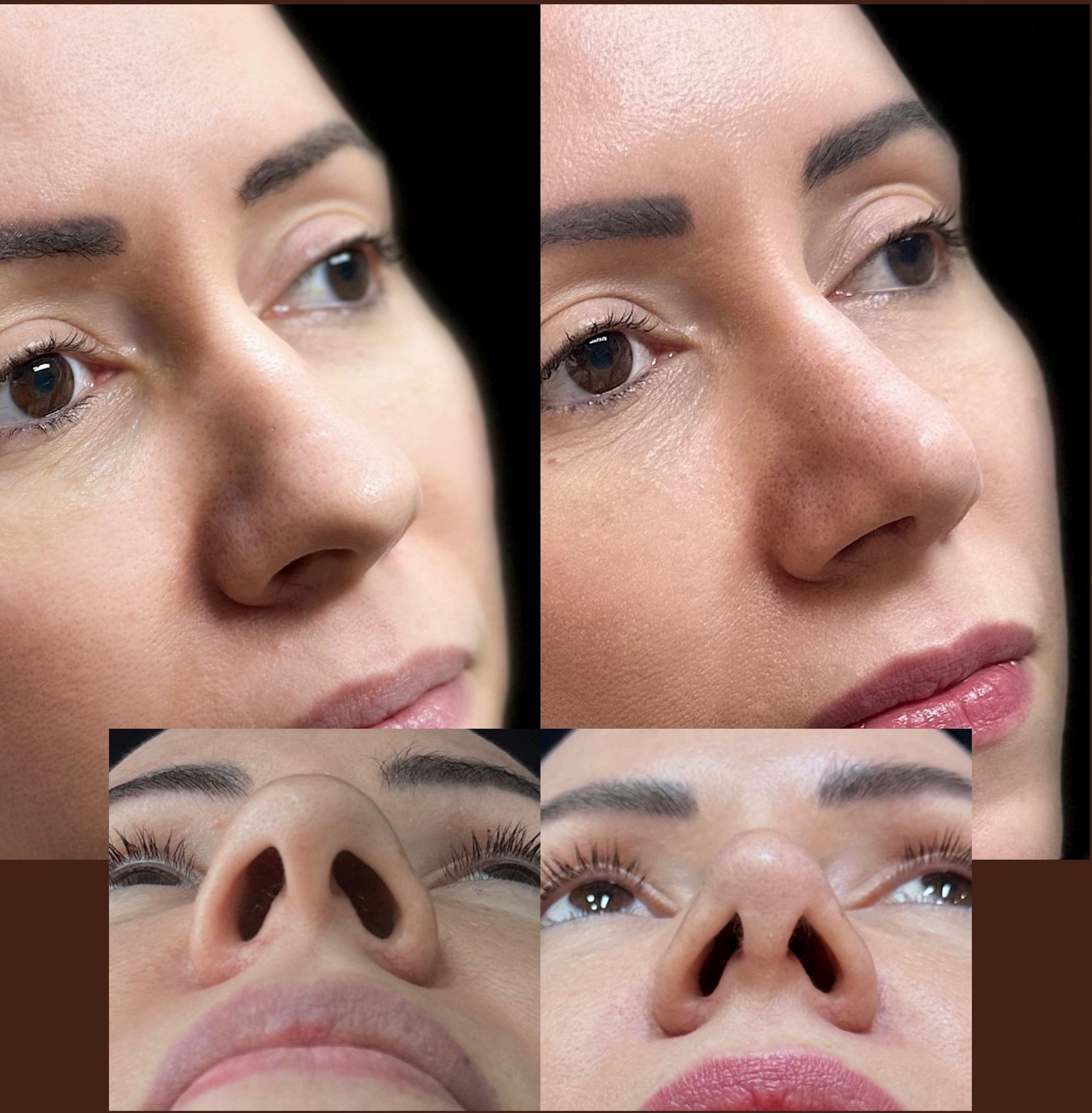 Antes e depois: Rinomodelação Estruturada