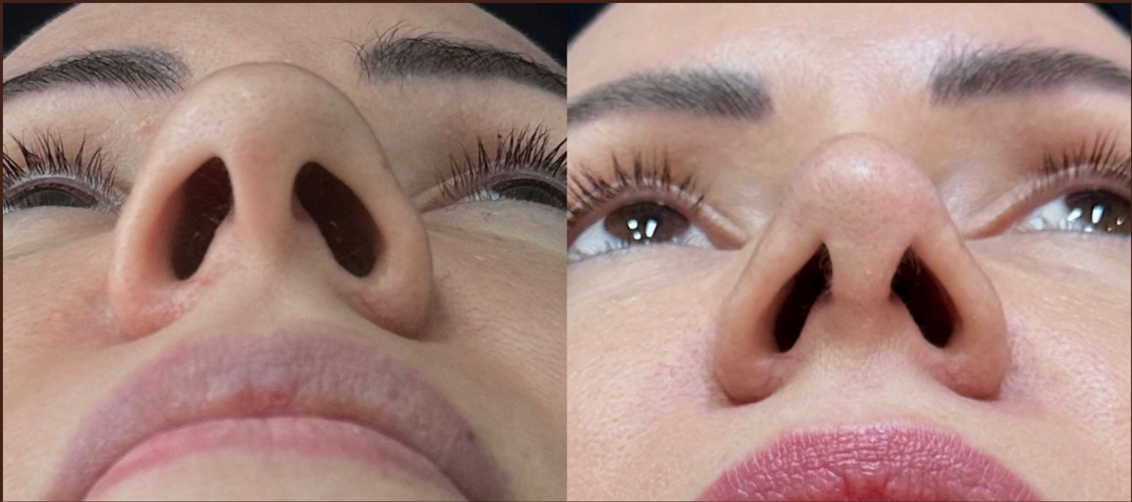 Antes e depois: Rinomodelação Estruturada