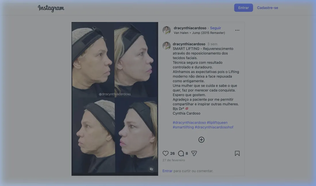 Smart Lifting Facial
